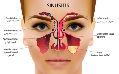 Sinusitis