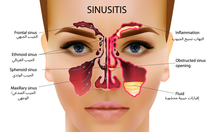 Sinusitis